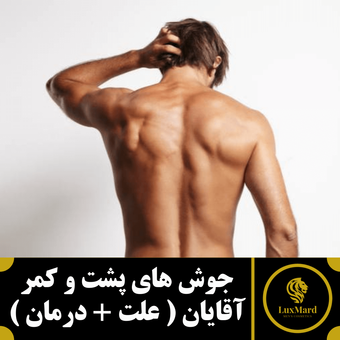 علت و درمان جوش های پشت و کمر آقایان