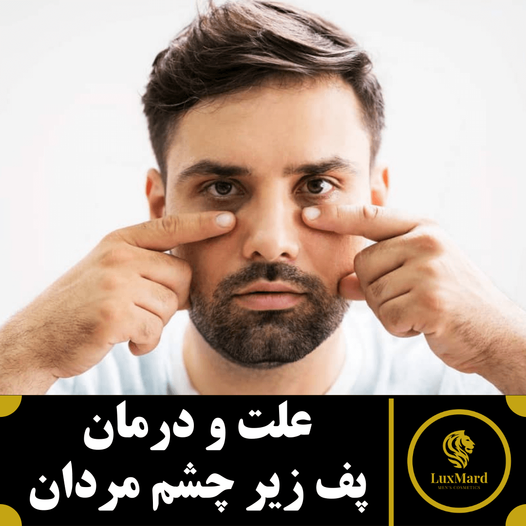 علت و درمان پف زیر چشم مردان