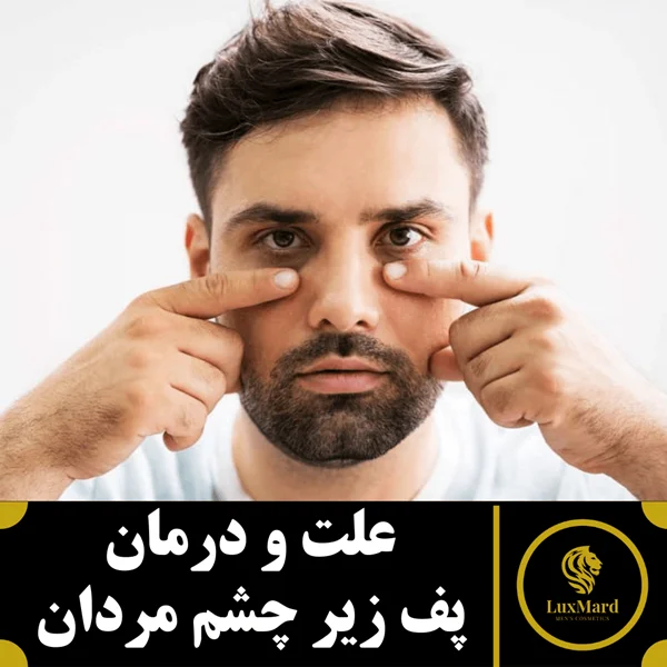 علت و درمان پف زیر چشم مردان